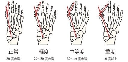 外反母趾の重症度