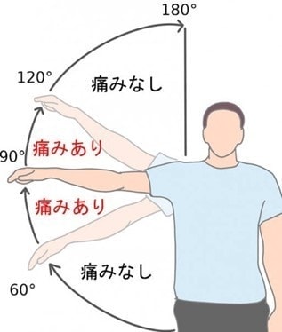 インピンジメント症候群