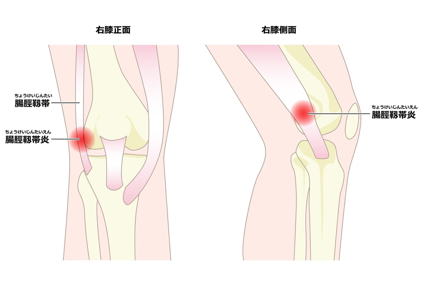 腸脛靭帯炎のメカニズム